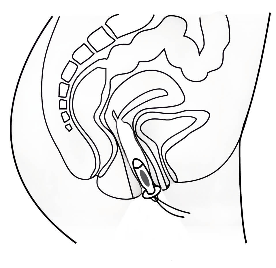 Promed IT-6 com sonda vaginal